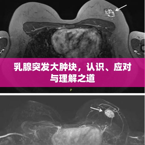 乳腺突发大肿块，认识、应对与理解之道