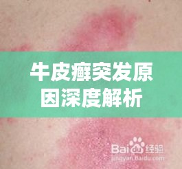 牛皮癣突发原因深度解析